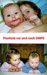 psoriasis-vor-nach-dmps